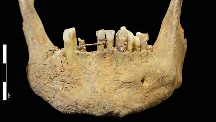 20-Carat Gold Wire Found in Scottish Skeleton May Be the Earliest Dental Bridge in Scotland